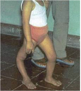 ポリオの後遺症により足に“まひ”が残った幼児